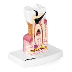 Miramarket Anatomski model obolelega človeškega zoba v merilu 6:1