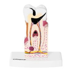 NEW Anatomski model obolelega človeškega zoba v merilu 6:1