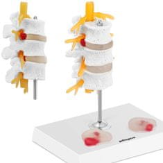 Noah 3D anatomski model ledvene hrbtenice s herniranim vretencem 3-5